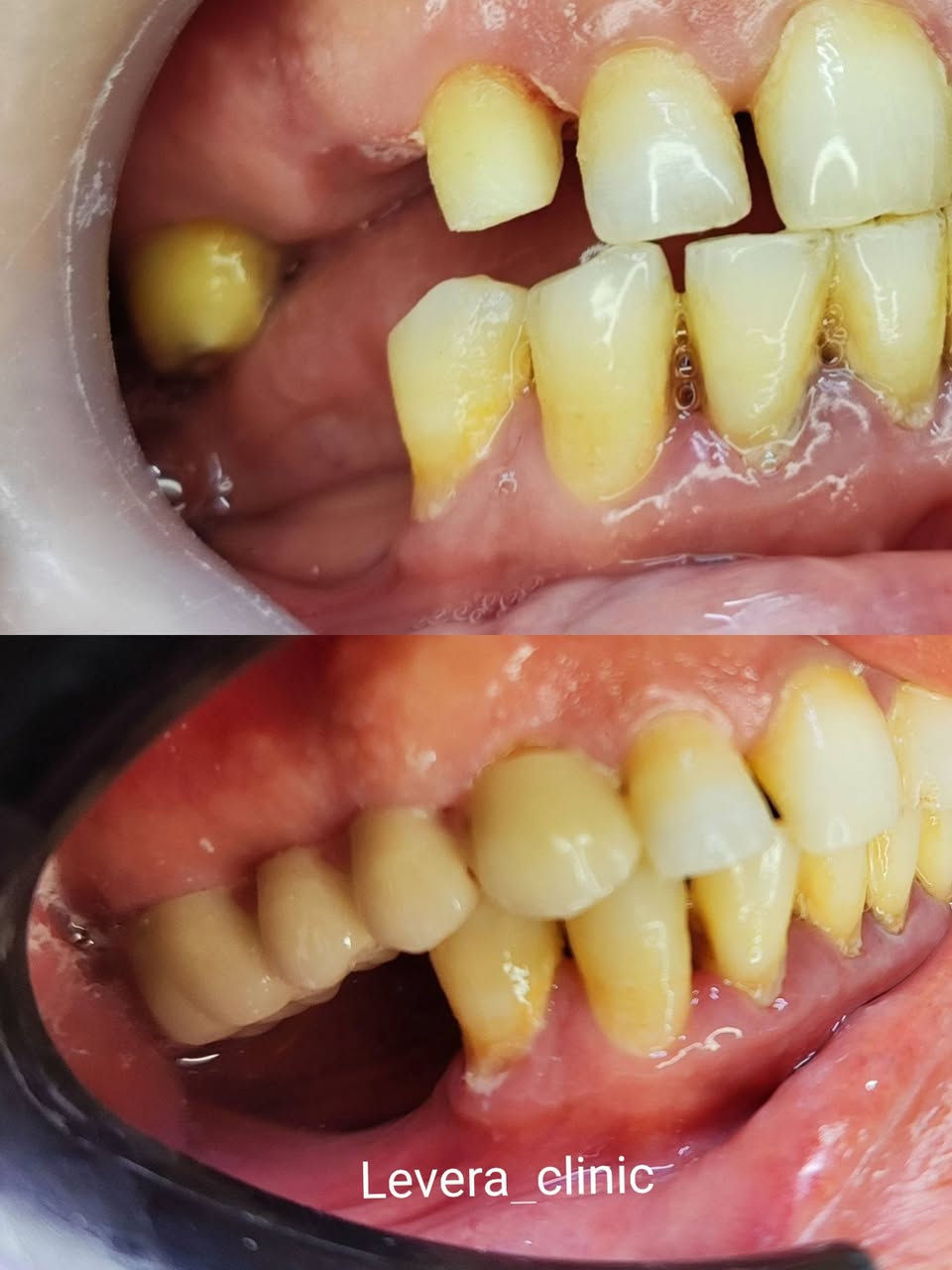 عيادة ليڤيرا لطب وتجميل الاسنان 
   نستقبلكم يوميا من الساعة 3 مساءً إلى 8 مساءٌ 
  أبتسامات عالية الجودة ضمان بالعمل 
    متابعة دورية بعد الانتهاء من العمل 

للحجز والاستفسار ***********
   أو زورو العيادة 
العنوان الناصرية-حي أريدو شارع مستشفى القلب مجاور الصيدلية النموذجية 

#أبتسامات #تركيب_اسنان #عيادةاسنان #حي_أريدو #الناصرية #أبتسامة_دايركت_فينيير #أبتسامة_هووليود

