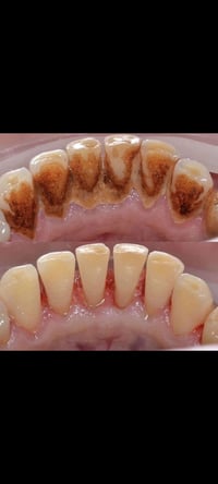 تنظيف أسنان • تكلسات • عيادات جامعة بلاد الرافدين