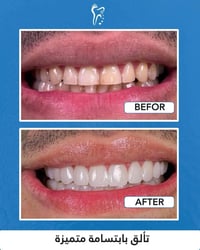 تبييض اسنان • البصرة الزبير • عروض رأس السنة