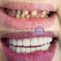تجميل الأسنان • مركز العالمي الطبي • ذي قار