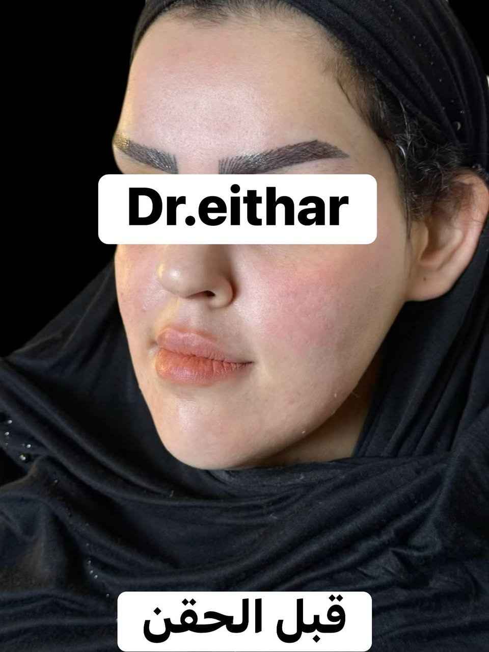 إلتغيير  والشد والشفة ولاغلطة 🔥🔥🔥
استداره وجه كامله بطريقه الشد ولفتتك 🔥رفع وجنات والاصداغ وتدوير الفك والذقن والخسفات ✨وفلر  الشفة 
د.ايثار سامي عبد الامير
الكوت الهوره مجمع القبطان طابق اول قرب كوزمتك احمد باريس
الحجز***********
