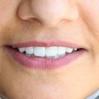 تغليف أسنان • الديوانية • دقة عالية