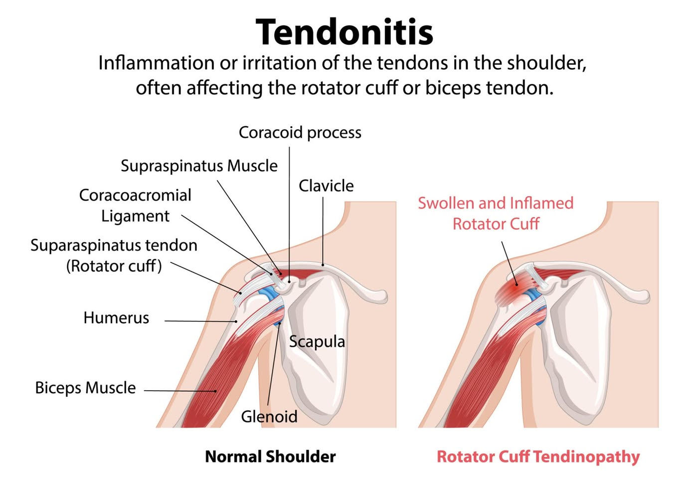 التهاب أوتار مفصل الكتف (Shoulder Tendinitis) هو التهاب أو تهيّج يصيب الأوتار المحيطة بمفصل الكتف، وغالبًا يحدث في أوتار عضلات الكفة المدورة (Rotator Cuff) أو وتر العضلة ذات الرأسين.
الأعراض الشائعة
• ألم في الكتف يزداد عند رفع الذراع 
• صعوبة النوم على جهة الكتف المصاب 
• ضعف في حركة الذراع 
• ألم عند ارتداء الملابس أو تمشيط الشعر 
• أحيانًا صوت طقطقة أو احتكاك داخل المفصل 
الأسباب
• الحركات المتكررة فوق مستوى الرأس 
• حمل الأوزان بشكل خاطئ 
• الإصابات الرياضية 
• ضعف عضلات الكتف 
• الجلوس الخاطئ لفترات طويلة 
• التكلسات أو الاحتكاك داخل المفصل مع التقدم بالعمر 
أكثر الأوتار إصابة
أوتار الكفة المدورة
العلاج الطبيعي
يعتمد العلاج على تقليل الالتهاب ثم تقوية العضلات وتحسين الحركة.
المرحلة الأولى: تقليل الألم والالتهاب
• راحة نسبية وعدم رفع الذراع بقوة 
• كمادات باردة 15–20 دقيقة 
• أجهزة العلاج الطبيعي: 
o TENS 
o Ultrasound 
o Laser Therapy 
o IFC 
• تمارين حركة خفيفة بدون ألم 
المرحلة الثانية: تحسين مدى الحركة
تمارين البندول
• يميل المريض للأمام ويحرك الذراع بشكل دائري خفيف. 
• 2–3 دقائق، عدة مرات يوميًا. 
المرحلة الثالثة: تقوية العضلات
تمارين المطاط العلاجي
تشمل:
• الدوران الخارجي 
• الدوران الداخلي 
• سحب الكتف للخلف 
• رفع الذراع التدريجي 
بروتوكول الليزر العلاجي
إذا كنت تستخدم جهاز ليزر علاجي مثل أجهزة NP Laser:
• التردد: حسب الحالة (غالبًا Anti-inflammatory mode) 
• مدة الجلسة: 5–10 دقائق 
• عدد الجلسات: 8–12 جلسة 
• التطبيق: 
o على وتر فوق الشوكة Supraspinatus 
o أمام مفصل الكتف 
o منطقة الالتهاب والألم 
أماكن شائعة للألم في أوتار الكتف
متى يحتاج المريض لفحص إضافي؟
يجب إجراء سونار أو MRI إذا:
• الألم شديد جدًا 
• ضعف واضح في رفع الذراع 
• عدم التحسن خلال 6–8 أسابيع 
• الاشتباه بوجود تمزق بالأوتار 
نصائح مهمة
• تجنب النوم على الكتف المصاب 
• تصحيح وضعية الرقبة والظهر 
• عدم العودة للرياضة بشكل سريع 
• الاستمرار على تمارين التقوية بعد التحسن لمنع رجوع الإصابة 

عيادة العـلاج الطبيعي والتأهيل الطبي
بإشراف نخبة من الأخصائيين
نقدّم خدماتنا لعلاج:
• الانزلاق الغضروفي القطني والعنقي
• ألم الرقبة والظهر والمفاصل
• شلل العصب السابع
• تحدد المفاصل وآلام الالتهابات
• الإصابات الرياضية
•علاج نتوء القدم
• علاج الشلل الدماغي وشلل الإطراف السفلى
• علاج التشنجات العضلية وتأهيل ما بعد الجلطات
   بأحدث أجهزة العلاج الطبيعي وبرامج التأهيل الحديثة المعتمدة عالميًا
   هدفنا مساعدتك على استعادة حركتك وحياتك الطبيعية
ملاحظة : كادر العلاج الطبيعي نسائي ، رجالي طيلة أيام الاسبوع 
من الساعة 3 والربع مساء للساعة 7والنصف ليلا
   العنوان: تكريت – شارع الزهور – فرع قاعة الشهيد ليث
مقابل روضة البنفسج – عمارة كهربائيات أحمد، الطابق الثالث يوجد مصعد في العمارة
📞 للحجز والاستفسار: ***********
