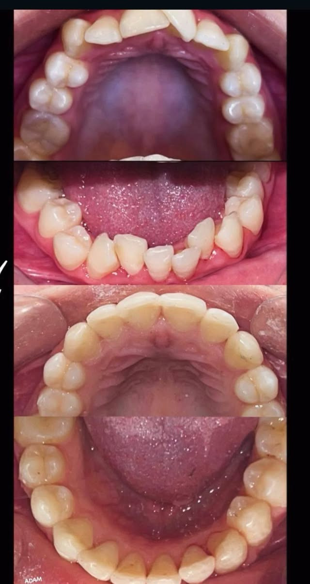 عروضض تكسر الدنيا لاهل الحسينيه وللناس الي تحتاج تسوي تقويم ومحتاره
عيادة السلام التخصصيه توفر لكم 
عرض التقويم فك الواحد ٤٥٠ الف وبالاقساط المريحه لعوائلنا الطيبة وباحسن النتائج 
شغل الطبيب راح ارفقه بالبوست 
*********** للحجز واتساب راسلوهم ومايقصرون وياكم ..
العنوان 
حسينية مدخل ثالث مقابيل بركر موسى 
مجاور صيدليه الطاقه الدوائيه.
