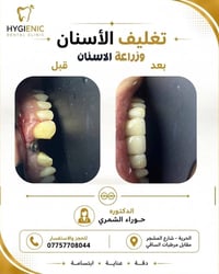 ✨ استعادة الابتسامة بثقة وجمال ✨ في هذه الحالة تم تعويض السن المفقود و...