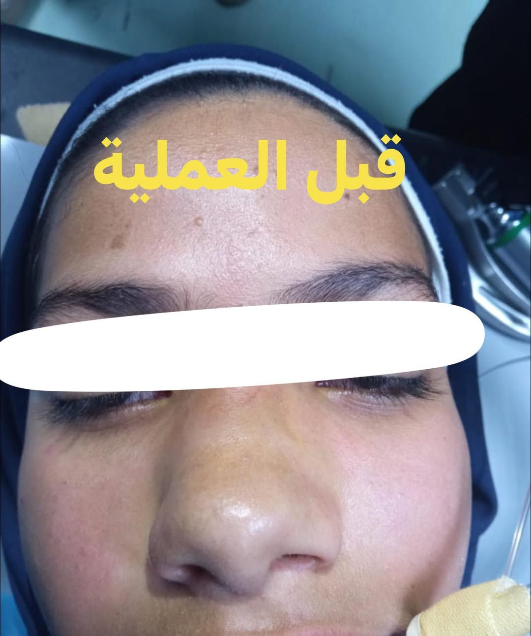 تم اجراء عملية تعديل  كسر عظم الانف اثر شدة خارجية لمريضة تبلغ من العمر ١٥ سنه حيث تم تقويم الكسر بدون جراحة خارجية و بدون اثر 

العنوان : حلة / شارع الطهمازية / مقابيل مستشفى التركي / مجمع  الخليج الطبي
أوقات الدوام طول ايام الأسبوع من الساعه ٤:٠٠ عصرا إلى الساعة ٨:٠٠ مساءا 
الجمعة من الساعة ٩:٠٠ إلى الساعة ١٢:٠٠ 
الخميس و الأحد عطلة العيادة

 رقم العيادة ***********
