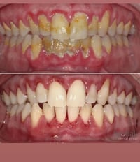 تنظيف أسنان • مجاني • جامعة الزهراوي