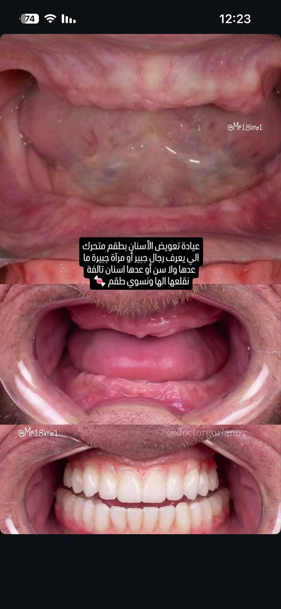 السلام عليكم 
الي يحتاج تعويض اسنان طقم كامل /قلع/تنظيف اسنان /حشوات يتواصل وياي على الخاص او على الواتساب 
***********
الموقع: جامعة اهل البيت الحر الصغير
