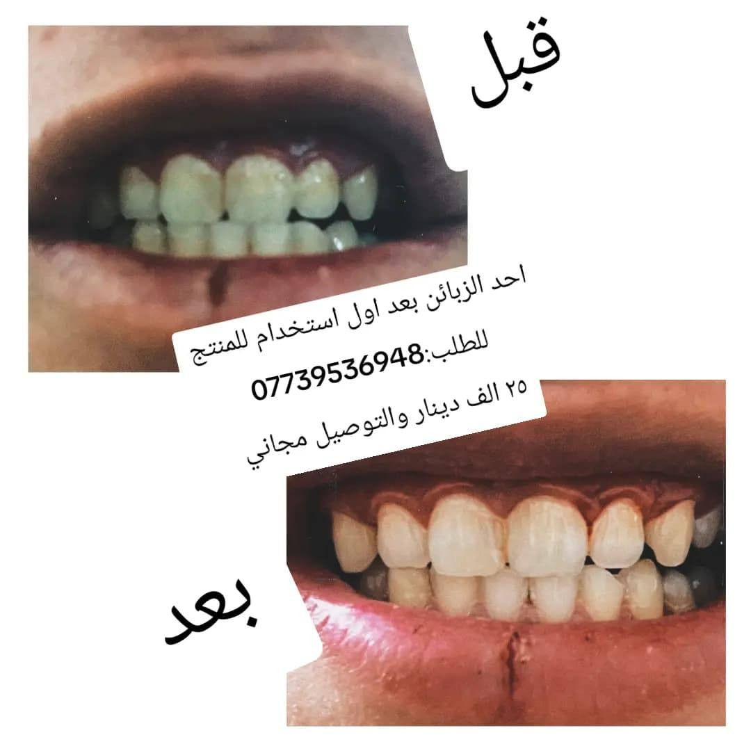 مبيض الاسنان من براند المهندس +هدية+فرشاة اسنان
العلبة الاولى تتكون من مكونات طبيعية ١٠٠٪
العلبة الثانية معجون المكونات الطبيعية
الهدية(عطر او مرطب او غسول او شامبو او احد منتجات البراند) 
للطلب المراسلة او التواصل على الرقم / ***********
كل هذا 25 الف دينار والتوصيل مجاني لكافة محافظات العراق 🇮🇶

* تستخدم المنتج وينطيك نتيجة گبال ابو التوصيل *
