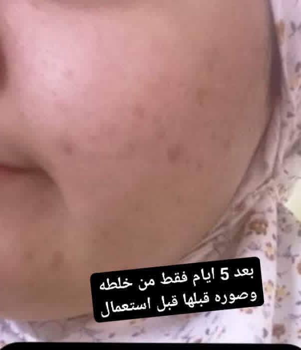 تريدين  بشررتج تصير تضوووي كيمرر جربي خلطه  الكلف وتصفيه خلطه امي عافيتي 💙🔥🔥🔥وشوفي النتائج بعينج تسووي وجهج كيمرر بيااض ثللج نضاره  لمعه تزيل الكلف ونمش وتصبغات توحد لون البشرة تنسين شي اسمه مكياااج  بشرتج تتفلتر


**إذا كنت صاحب هذا الإعلان وتريد حذفه لأي سبب، رجاءا أرسل رسالة إلى الدعم الفني**