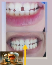 حشوات تجميلية • عيادة الناحية • د.حمزة صباح