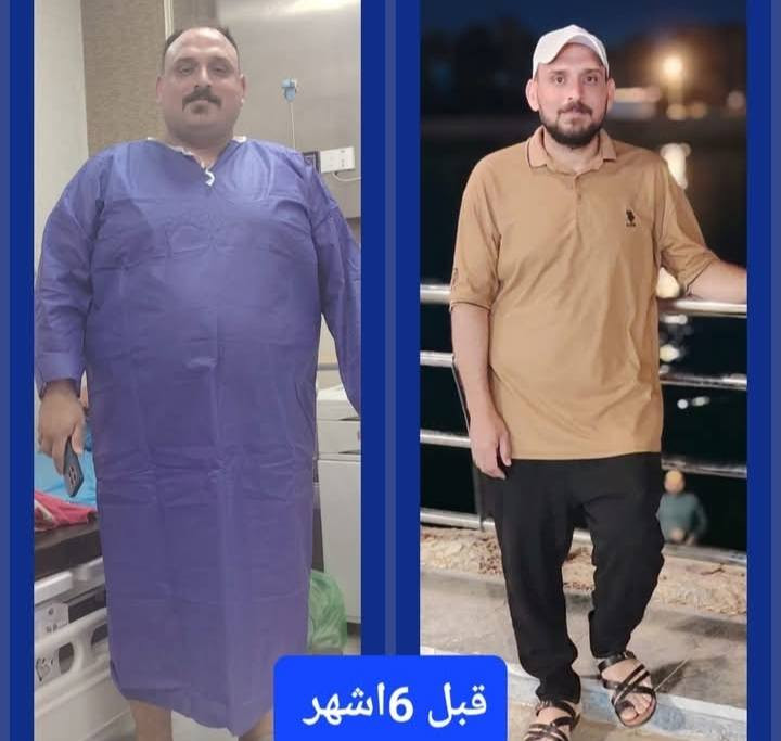 بشرى ساره لأهلنا في محافظة واسط (قضاء الصويره) والمحافظات الجنوبية والفرات الأوسط
@الجميع
مع البروفيسور الجراح
الدكتور. محمد الطائي
يتواجد الدكتور كل يوم خميس لأجراء العمليات 
والأستشاره الطبية

عملية قص المعدة 
(مليونين و٦٠٠) شاملة
عملية تحويل المسار 
( 4 مليون) شاملة
عرض لفترة محدودة 

هذا العرض يشمل :
1- مجموعة مستشفيات المؤيد. 
مستشفى المؤيد الاهلي(3) في قضاء الصويرة / شارع النجمة.

2- كافة تحاليل العملية والفحوصات التي تشمل 
(الأشعة + السونار + الأيكو +  تخطيط القلب). 

3- علاج العمليه والرقود. 
 
4- رقود لمدة يومين. 

5- عناية طبية من قبل الطبيب المقيم للبروفيسور... وتمريضية متميزة من قبل كادر متكامل. 

6- كافة مستلزمات العملية. 

7- كراس نظام غذائي علاجي مطور ما بعد العملية. 

8- متابعة فعلية مابعد العملية عن طريق كروب من قبل البروفيسور. 

9_الادوات الامريكية الجيل الثالث حصرا الاحدث في عالم عمليات السمنة. 

للحجز و الاستفسار:
***********.
***********.
إدمن محمد

#محمد_الطائي
