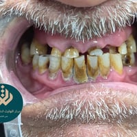 تغليفات زيركون • عيادة أسنان • الناصرية