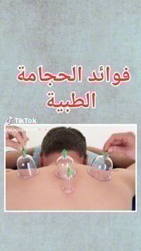 حجامة • بسمايه • صداع وشقيقة