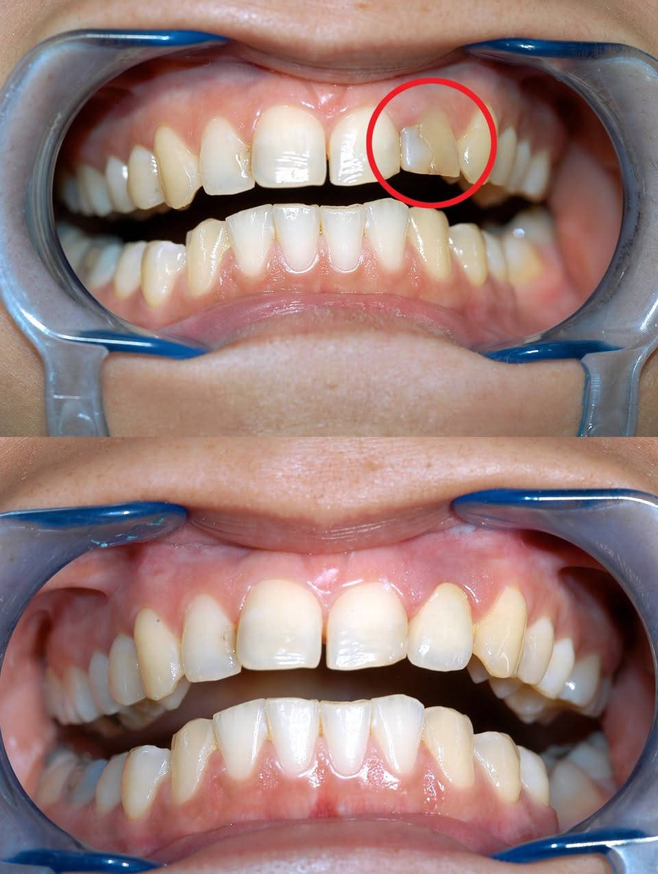 بعد اليوم لا وجع ولا تردّد ✨
حشوة ضوئية 20 ألف
حشوة جذر 20 ألف
تنظيف أسنان 15 ألف
قلع الأسنان 20 ألف
تبييض بالليزر + تنظيف 50 ألف

تراكيب ثابتة ومتحركة بأسعار تنافسية 🔥
خصم 50% لفترة محدودة 

للتواصل : ***********
