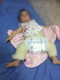 الخلع الولادي لمفصل الوركين هو من التشوهات الولادية الشائعة وخصوصا في ...