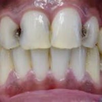 حشوات تجميلية • علاج مجاني • جامعة اهل البيت