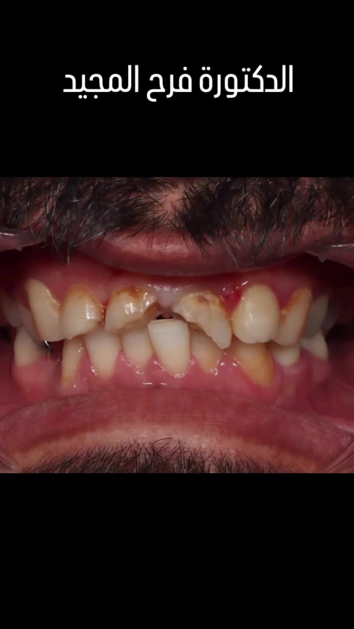 🤩المراجع اتعرض لضربة ادت الى كسر الاسنان الامامية تمت المعالجة بيد الدكتورة فرح مجيد 
اختصاص تجميل الاسنان🥰  خبرة ١٤ سنه بالعمل💯👏
بعقوبة💞 مدخل شفته الرئيسي
*********** واتساب❣️
