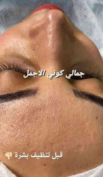 عروض كرسمس ،🎆🎀🎆
حفافة فقط 8

تنظيف بشرة 10بجهاز الهايدوفشل 

حفافة مع تنظيف بشرة بجهاز الهايدوفشل 15

المجموع قبل العرض 28

العرض صار المجموع 15
 

دللي نفسج وبسعر 15فقط 
حفافة مع تنظيف بشرة  كل هذا بسعر 15
صبغ الشعر القصير جداٍ بسعر 15 
الوسط 15
الطويل 25 

صبغ وميش للشعر القصير 35
فقط ميش 25
صبغ وميش للشعر الوسط 50
فقط ميش 35
صبغ وميش للشعر الطويل 65
فقط ميش 50

دكتورة رصابرين خبيره تجميل
عرض اول مره يصير حصري يمنا 
 
فلر كوري براند السعر السابق 150
السعر حالين سيسي واحد ب50
عرض يجنن ستغلو العرض ميتكرر

العرض ينتهي يوم 1/1

العنوان.  كربلاء قنطرة السلام
صالون الروان

💜أهلا وسهلا  ) 

الحجز وتساب ***********
H .M c🪻🪻🪻🪻🪻🪻🪻🪻🪻🪻🪻🪻🪻#عيادات_تجميل #اطباء #مراكز_تجميل #مخدر_موضعي #فلر #ميزوات #بلازما_البشرة #طبيبات_جلدية  #بغداد_العراق #صالونات #ميزو #فلر #ميزو_فلر #مراكزتجميل #عيادات_تجميل #اطباء #صالونات #بغداد_العراق #مستحضرات_تجميلية#بوتوكس #ميزو #بشره #جلد #جمال #فلرات #شفاه
@إشارة
