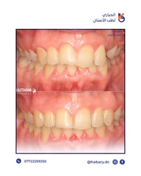 العضة العميقة • تعديل ابتسامة • تقويم أسنان