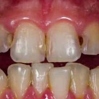 علاج اسنان مجاني الي عنده هيج التسوسات ويريد نعالجهم بحشوات ضوئيه يتوا...