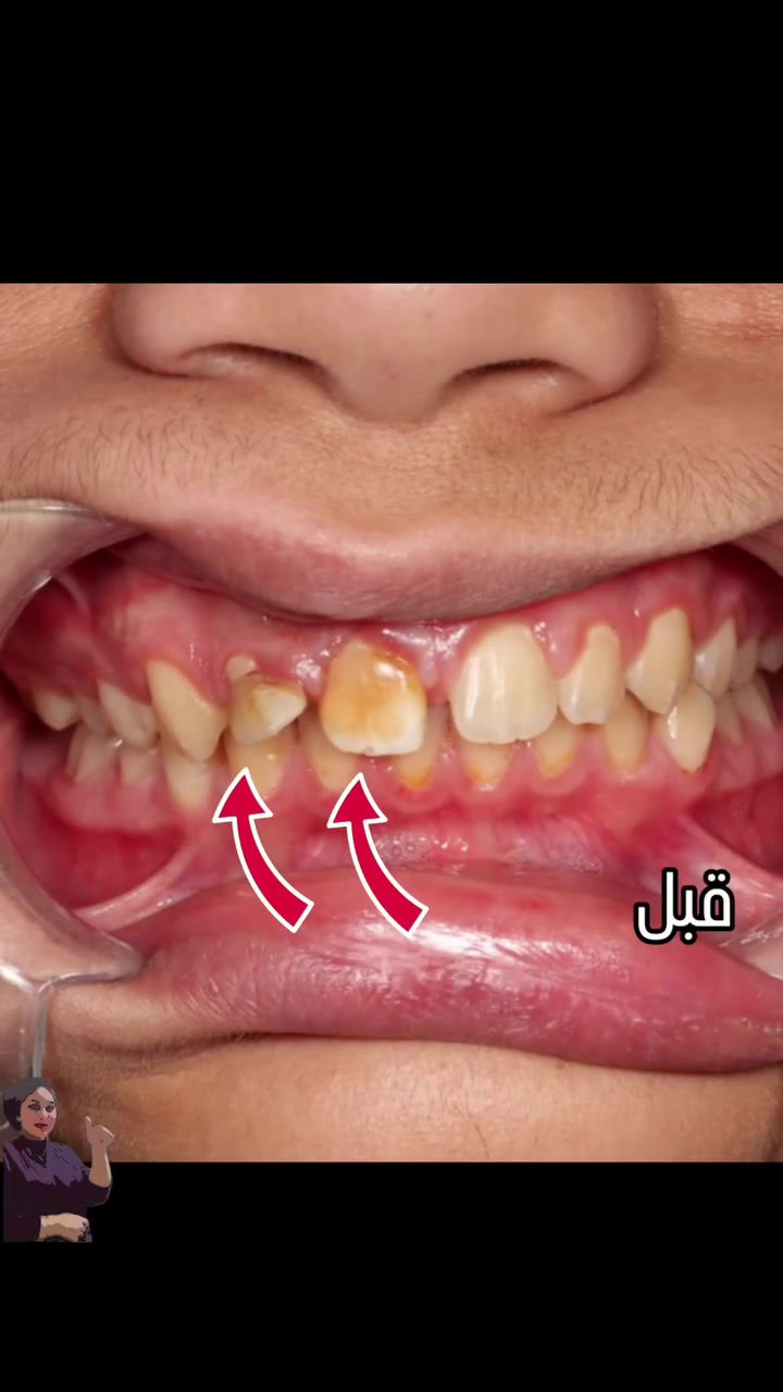 👈شغلي وجمالة بتجميل الاسنان🤩 الامامية بيد دكتورة فرح #اختصاص تجميل الاسنان💯 خبرة ١٤ سنه بالعمل 
#ارقى الماركات #ضمان بالشغل #انسب الاسعار 😇
بعقوبة ☘️مدخل شفته الرئيسي
***********☎️
