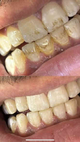 اعلااان🏅

السلام عليكم
بعد الانقطاع بسبب عطله الانتخابات
عياداتنه رجعت من جديد 
جاهزين لارجاع ابتساماتكم  والضحكه الحلوه على وجوهكم الجميله

وبشكل مجااااني

شنو الحالات الي نشتغلها؟
١-حشوات تجميليه ضوئيه
٢-تنظيف وازاله التكلسات والتصبغات
٣-قلع الاسنان التالفه او الجذور المتبقيه
٤-تعويض الاسنان المفقوده بطقم

موقعنا: كربلاء - حي الموظفين- خلف مشفى الولاده- عيادات جامعه كربلاء

زين انتو طلاب وجاي تطبقون بينه وتتعلمون مو صح!!

هاي جانب من شغل طلابنا شوف واحكم بنفسك.

للتواصل:***********
