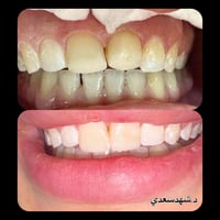 مرحبا بنوتات  شلونكم وياكم د.شهدسعدي اخصائيه تقويم و سرتفكيت تجميل اسن...