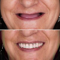 طقم أسنان متحرك • طبيعي ١٠٠٪ • كربلاء