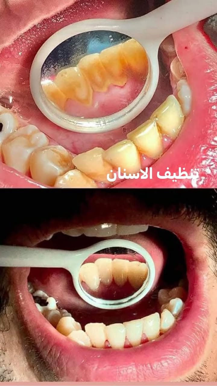 اللي يريد يحجز يتصل او يدز عالخاص 

عيادة طب الاسنان 
تقويم الاسنان ،، زراعة الاسنان ،، حشوات تجميلية
تركيب الاسنان (سيراميك و زارگون)،، حشوات جذور ،، قلع،، حشوات مؤقتة ودائمية ،، تنظيف وتلميع الاسنان ،، تبييض الاسنان بالليزر 
متواجدين طيلة أيام الاسبوع 
للحجز والاستفسار ع الخاص او ع الرقم 
*********** واتساب 
العنوان .. الامين الثانية شارع البنازيخانة يم السوگ 
قریب ع افران السلام واسواق الشارقة مقابل محلات الصبيحاوي
مجمع دكتورة رجاء محمد نصيري
