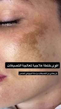 خلطة ام سعود • تفتيح البشرة • علاج حب الشباب