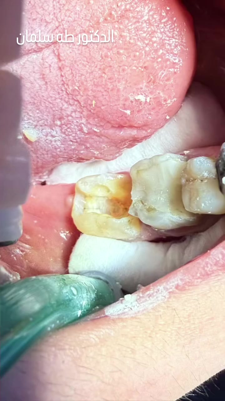 ✨️ يتواجد اليوم 
👨‍⚕️ الدكتور طه سلمان 

↩ أختصاص تقويم
أختصاص تجميل الأسنان 

🔸️ابتسامه هوليوود 
🔸️ عمل تقويم أسنان 
🔸️تبييض الأسنان 

🔸️ قلع 🔹️حشوات 🔸️زراعه الاسنان 🔸️تنظيف الاسنان 🔸️تركيب الأسنان 
 ــــــــــــــــــــــــ
🔴 فحص الأسنان مجانا يحدد بعد المعاينة 

📝ونستقبل كل الحالات حتى الأطفال 
ـــــــــــــــــــــــــ
  فــــــي
#مجمع_علم_الڪندي_الطبي_التخصصي 
🏥 العنوان /  أول مجمع طبي بعد الخروج من بوابه B ( البوابة الجديدة ) قريب من أسواق زاد الخير 
ـــــــــــــــــــــــــــــ
⏰️ متواجدين يومياً  من الساعة 4 عصراً الى الساعة 10 مساءاً
ـــــــــــــــــــ
للحجز والاستفسار 
📲 ***********
( متوفر واتساب ) #مجمع_علم_الڪندي_الطبي_التخصصي #بسماية #بسماية_بغداد❤️ @alam_alkindy
