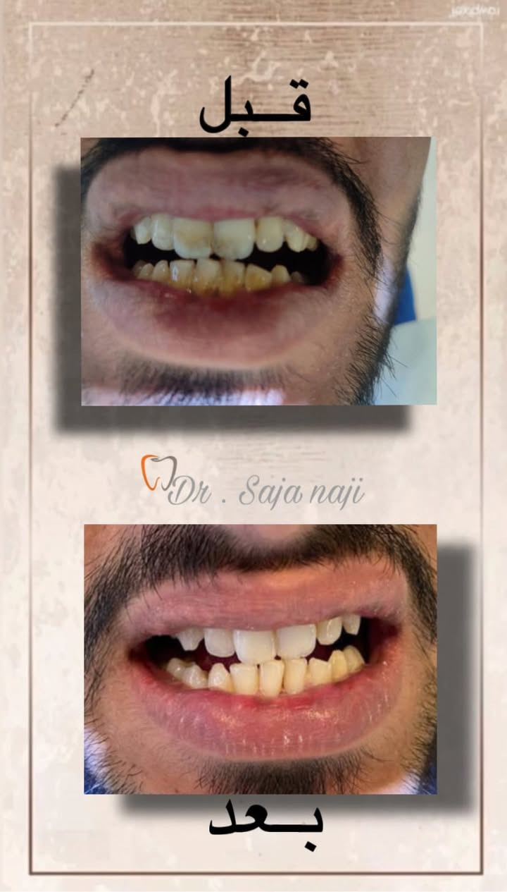 🦷✨ عيادة الدكتورة سجى ناجي

🎉 عرض خاص بمناسبة العيد ولمدة محدودة
فحص الأسنان مجاناً

✔ حشوات تجميلية
✔ علاج عصب
✔ قلع الأسنان
✔ تنظيف وتلميع

💥 عند عمل حشوتين
🎁 تنظيف الأسنان مجاناً

🎊 عروض وخصومات خاصة بالعيد
🔥 لأول 10 مراجعين فقط

📍 الموقع: بابل – الحلة – شارع الأربعين
📞 للحجز والاستفسار: ***********

😊 ابتسامتكم سر ثقتنا
