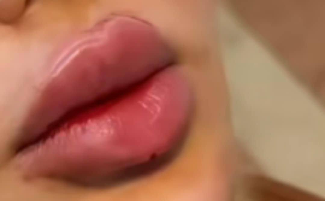 عروض الفلر نوعيته كلو بلاص الفرنسي ،والايطالي السيسي 50البلازمه المفعله بي اربي 30الجلسه والبوتوكس الكندي 40 وتغير وجه كامل  بلفلر  250 والغمازه 25 والبرنسك 25باختصاص دكتورة بنات هاي عروض بصالون الانيقه ***********
