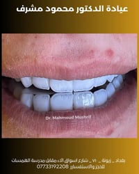 من ابتسامة متعبة… إلى ابتسامة تخطف الأنظار ✨🦷  نتائج سريعة، تفاصيل دقي...