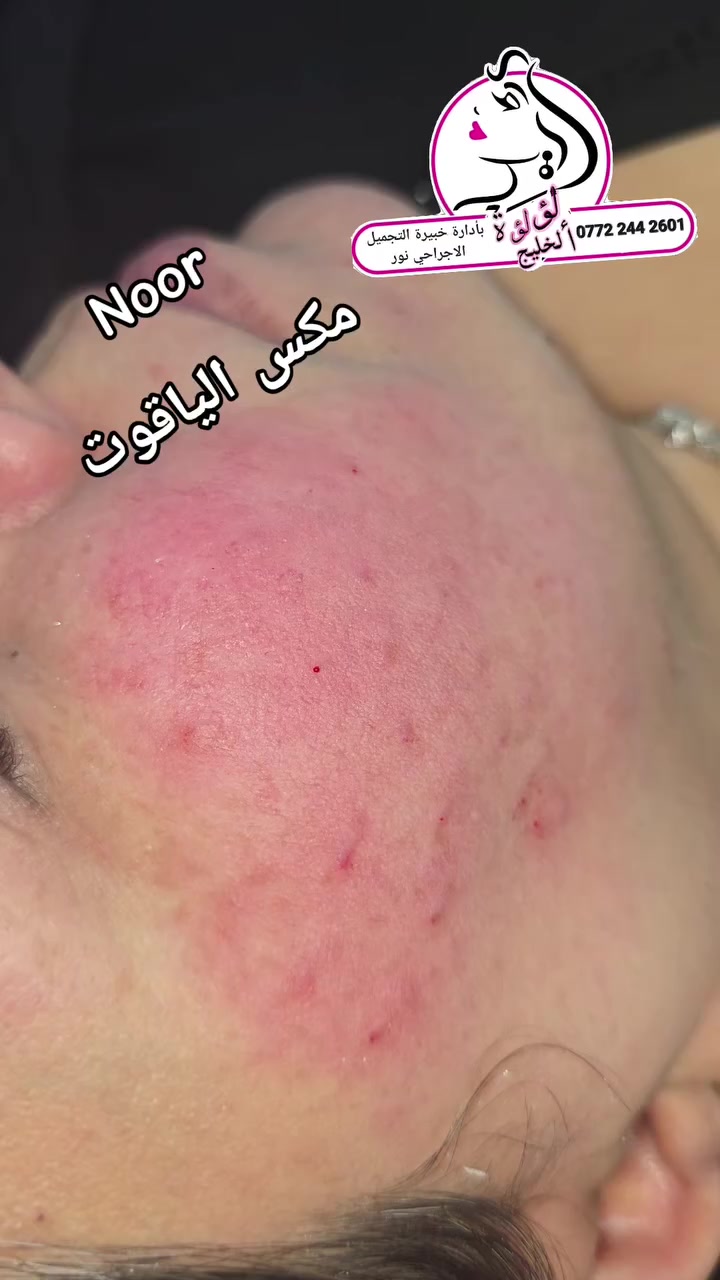 عروض الفلر الكوري التغير شامل ١٠سيسي سيسي فلر ب ٢٥٠ الف
١٥فلر سيسي ٣٥٠ الف 
فلر كوري سيسي شفه ٥٠ الف 
فلرشفه سويسري سيسي ٧٥ الف 
العنوان بغداد الامين الثانية سكينه
 الحجز ***********
