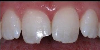 🦷✨ تعاني من تسوس أو كسر بالأسنان؟

حتى الحالات المتضررة بشدة نكدر نعالجها ونرجّع للسن شكله الطبيعي ووظيفته 💪

🔹 علاج تسوس الأسنان
🔹 ترميم كسور الأسنان التجميلية
🔹 حشوات تجميلية بلون السن
🔹 علاج بإشراف أطباء اختصاص

👩‍⚕️ العمل يتم من قبل طالبة طب أسنان
وبوجود ومتابعة أطباء اختصاص لضمان أفضل نتيجة ✔️

لا تخلي الألم أو شكل السن يأثر على ابتسامتك 😊

📩 للحجز والاستفسار راسلنا على الواتساب  
📞 رقم التواصل: ***********
