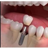 ✨ عرض رأس السنة ✨🎉 ابدأ السنة الجديدة بابتسامة ثابتة وواثقة 😁  🦷 خصم 2...