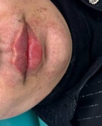 فلر شفه • ١ سي سي