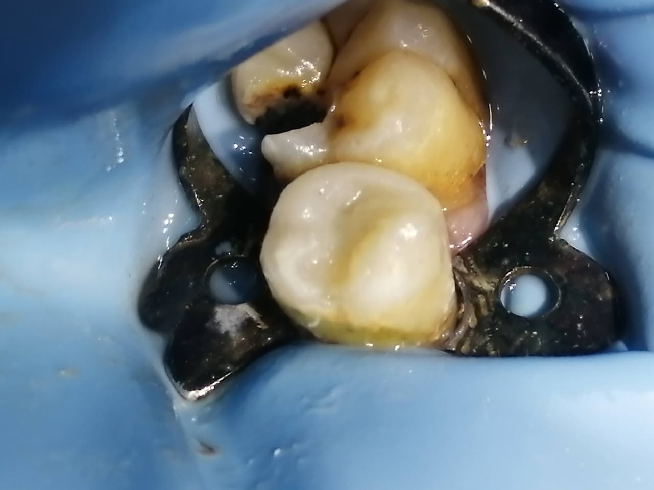 ترميم السن الضاحك السفلي بحشوه جذر مع حشوه تجميليه.. د مهند عبد الجواد الطحان.. ماجستير ودبلوم عالي تعويض الأسنان.. سايدين مستشفى القياره.. مقابل باب الطوارى.. مجاور صيدليه عبدالله المعماري.. طابق ارضى.. للحجز والاستفسار التواصل على الرقم ***********#
