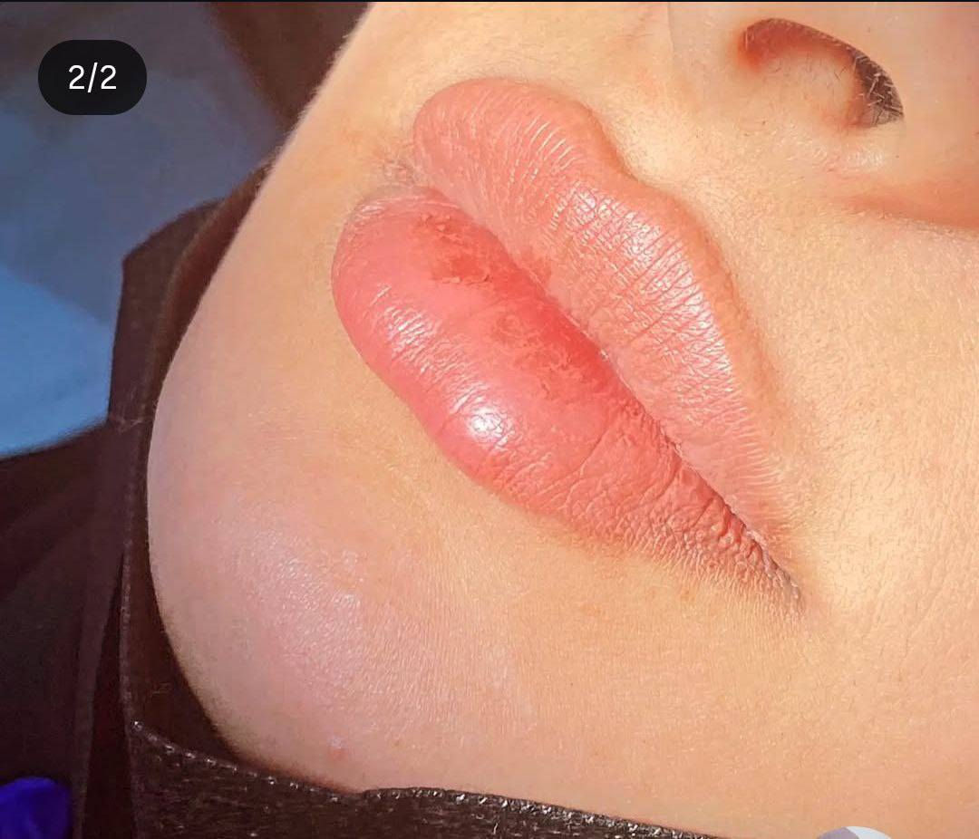 يوجد في عيادة ايفنت لطب الأسنان والتجميل
قسم التجميل لاجراحي 
يشمل 
الفلر
البوتكس 
ابر نظارة 
محفزات كولاجين  إبرة الكالسيوم وغيرها
البلازما والخلايا الجذعية للوجه والشعر 
التغير الشامل
مع نتائج مضمونة

*********** للتواصل بخصوص التجميل
بيجهم على الانستكرام 👇 
https://www.instagram.com/event.clinic?igsh=MTc3NG0ycTdxMjhxYw==
