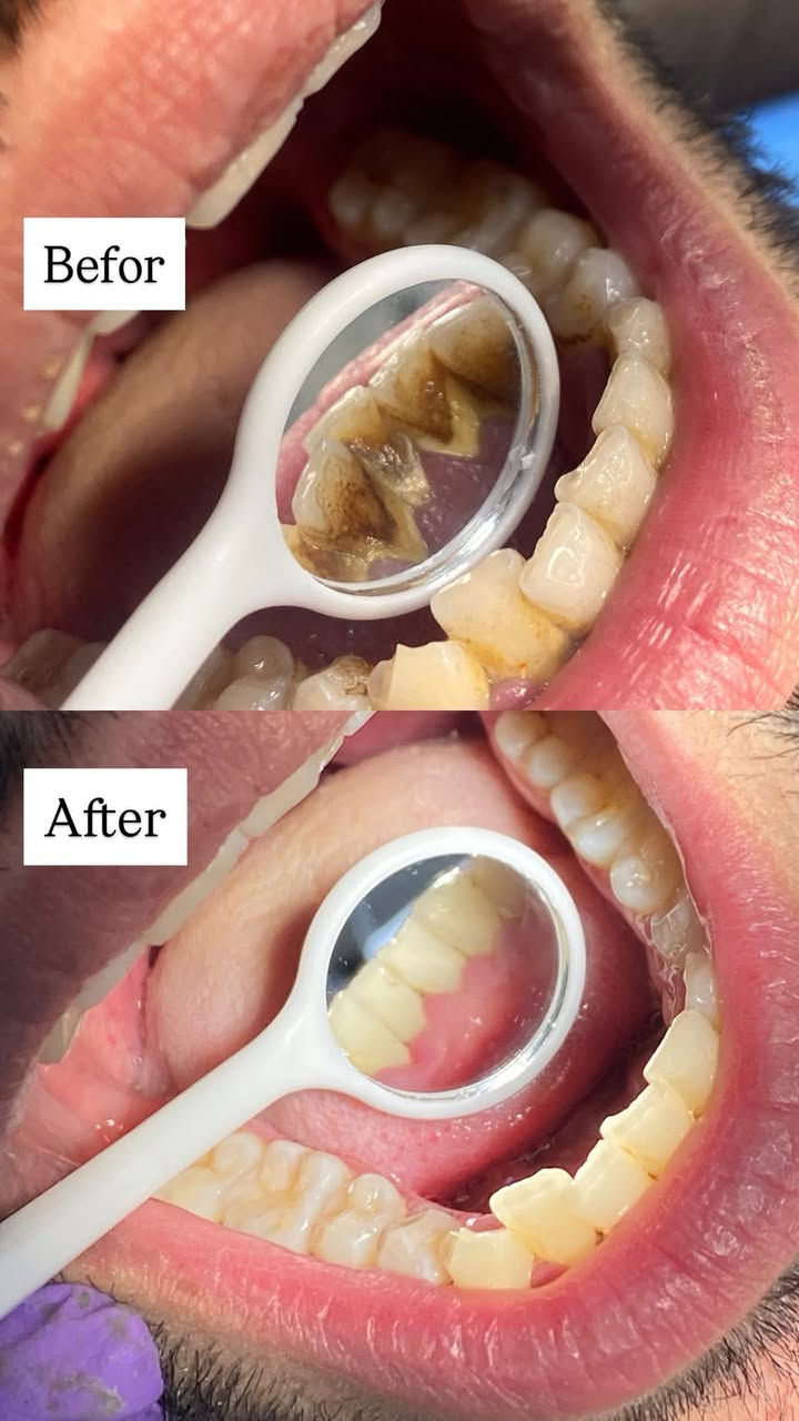 الي يحتاج قلع اسنان وجذور تالفه وتنظيف اسنان وحشوات ضوئيه يوجد مجااااني يراسلني خاص 🩵


**إذا كنت صاحب هذا الإعلان وتريد حذفه لأي سبب، رجاءا أرسل رسالة إلى الدعم الفني**