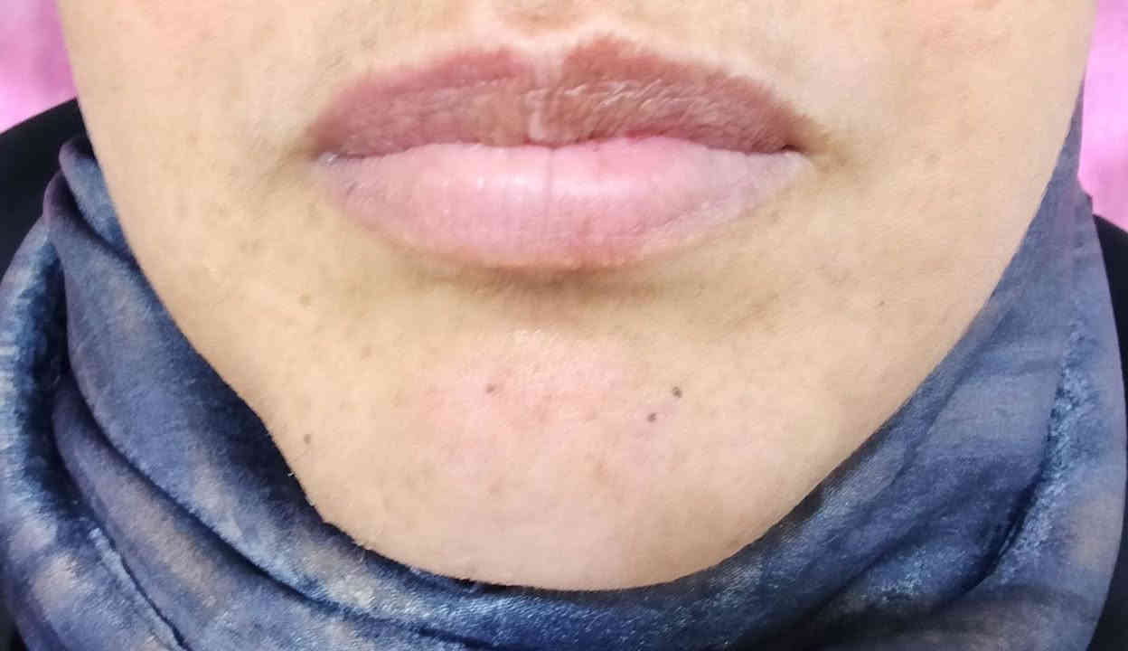 لأن شفاهكِ هي عنوان أنوثتكِ، حرصنا في [ عيادة المينا كلنيك ] أن نمنحكِ اللمسة التي تبرز جمالكِ الطبيعي دون مبالغة. 💋
سواء كنتِ تبحثين عن:

​توريد ونعومة تدوم طويلاً.

​تحديد دقيق يرسم ابتسامتكِ بوضوح.

​أو حجم مثالي يتناسق مع ملامح وجهكِ.

شارع الأطباء / فرع صبار / مقابل عياده الدكتور محمد سعود 

***********
​ 

​#فيلر_شفايف #تجميل #نضارة #فيلر #ابتسامة_هوليود #تجميل_الوجه #عيادات_تجميل #جمال_طبيعي #LipFiller #BeautyTips #Filler #Lips
