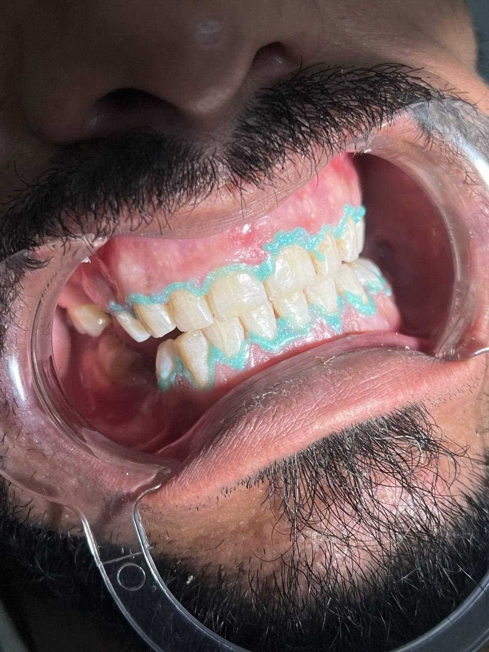 ✨ لأن ابتسامتك تفرق… إحنا نهتم بيها ✨
🦷 عيادة الدكتور د. احمد عَراك   لطب الأسنان
تعلن عن تخفيضات خاصة على جميع إجراءات الأسنان
بأيدي خبيرة، عناية دقيقة، وأسعار تناسب الكل 🤍
🔹 التغليفات:
• السيراميك: 50 ألف
• الزركون: 60 ألف
🔹 تنظيف الأسنان:
• 10 آلاف بدل 25 ألف
🔹 الحشوات التجميلية:
• 10 آلاف للسن الواحد
🎁 وعند عمل جلستين حشوات، جلسة تنظيف مجانية
لأن راحتك وصحة أسنانك تهمّنا، وفرنالك أفضل العلاجات بدون تأجيل
خلّي ابتسامتك اليوم أحلى من باچر 😁🦷
📍 العنوان: بغداد – الحسينية
مدخل التكاسي، مجاور لحوم الحسنات
📞 يرجى الحجز مسبقًا لتثبيت الموعد:
***********
