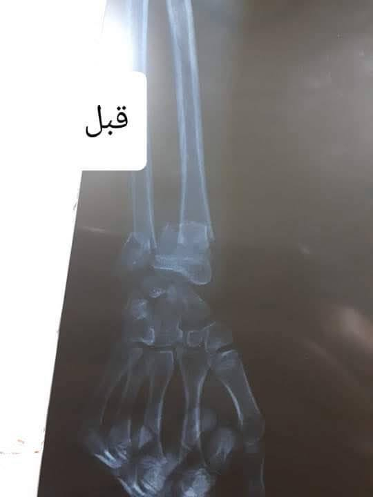 ⌛السلام عليكم⏳

سحب وتعديل لكسر معقد  بدون تداخل جراحي النتيجه 
الحمدلله  
                            الدكتور
                     ياسر يوسف العبيدي 
            اختصاص جراحة العظام والكسور 
البورد العربي( دكتوراه )جراحة العظام والكسور 
#كسور #تبديل_مفصل_الركبة #تبديل_المفصل_الورك #جراحةالعظام🦴_والمفاصل #جراحةالعظام #جراحة_العمود_الفقري #الانزلاق_الغضروفي #ناظور_الركبه #الاصابات_الرياضية #القدم_السكري
# متواجد في عيادته كل ايام الاسبوع عدا يوم الجمعه من الساعه 2:30مساء الي الساعه 5:00 مساء خلال شهر رمضان المبارك
 مجمع وصيدليه محمدسعيدحمدان 
للحجر والاستفسار ***********ك
هيت شارع الاطباء
