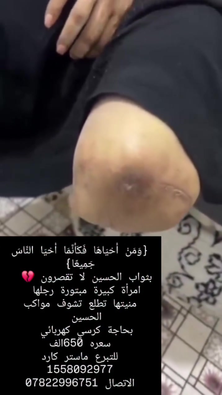 {وَمَنْ أَحْيَاهَا فَكَأَنَّمَا أَحْيَا النَّاسَ جَمِيعًا}
بثواب الحسين لا تقصرون 💔  
امرأة كبيرة مبتورة رجلها  
منيتها تطلع تشوف مواكب الحسين  
بحاجة كرسي كهربائي  
سعره 650الف
للتبرع ماستر كارد 1558092977
الاتصال ***********
