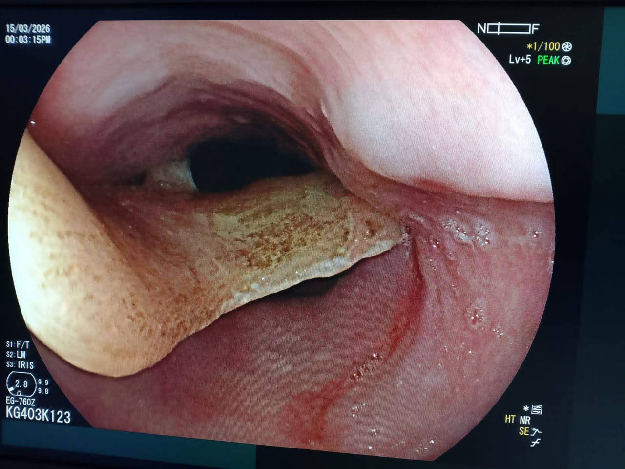 #يوم 15/3/2/26 #اثناء صباح رمضان المبارك استقبلنا #رجل ستيني  #ابتلع #سن اسنان #صناعي كبير جدا مع عموده #الحديدي #المعقوف  متوقف في وسط البلعوم  وبين اكمال الاجراءات وارسال الاشعة تم تأكيد المكان وتحضير كادر المناظير المتقدم الاخ ابو ليان مرتضى و الأخ امجد ابو مقتدى 
وبمتابعة #مقيمنا البطل الطبيب الاقدم
#أجرينا #باشرافنا له #ناظور تداخلي واستخرجنا السن مباشرة ولكن #بصعوبة بالغة جدا لان #السن كان كبير وفيه الحديد #المعقوف على هيئة #الشص لصيد السمك.كما موضح بالصورة 
#نرفق مع المنشور إحدى #هدايا الإخوان من قضاء #الرفاعي درع #التمييز من قبل اخينا الفاضل #ايمن #ثجحيل وذوقه الرفيع في تكريمنا .
 #الطبيب #الاستشاري #د.يعقوب يوسف الكوفي 
 #فوق التخصص دقيق 
#أمراض ومناظير الجهاز الهضمي والكبد 
***********
