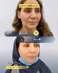 حقن شحوم ذاتية • مركز تجميل خانقين • تجميل الوجه • حقن الدهون • نضارة ...