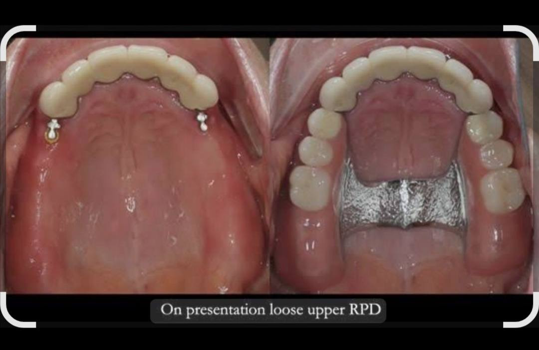 السلام عليكم
الأشخاص الي فاقدين جزء من أسنانهم و يريدون يعوضوها بطقم جزئي متحرك يراسلني و العلاج تحت أشراف أطباء أختصاص
العنوان جامعة المعارف كلية طب الأسنان
و بأسعار رمزية تُدفع للمختبر فقط
للحجز و الاستفسار يرجى التواصل على هذا الرقم و بي واتس ***********
