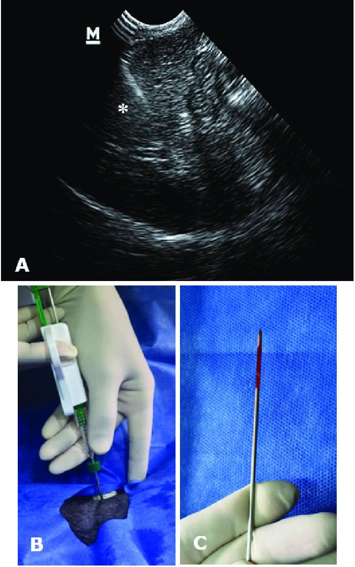 📣لاول مره في مدينة تلعفر  وغرب نينوى 📣
 

نعلن عن توفير خدمة أخذ خزعة الـ Tru-Cut
في مختبر غرب نينوى التخصصي

 💉 شنو هي إبرة الـ Tru-Cut؟

إبرة Tru-Cut هي أداة طبية خاصة تُستخدم لأخذ خزعة نسيجية (Core Biopsy) من أي كتلة داخل الجسم، حتى نقدر نفحصها 
تحت المجهر ونعرف طبيعتها بدقة.

🪬شنو تفرق عن الإبرة الرفيعة (FNA)؟
 • FNA تأخذ خلايا فقط.
 • أما Tru-Cut تأخذ قطعة نسيج كاملة فيها خلايا + ستروما + ترتيب نسيجي.
وهذا يخلي التشخيص أوضح خصوصًا بحالات الأورام.

شنو أهمية خزعة الـ Tru-Cut؟

1️⃣ دقة أعلى بالتشخيص

إبرة الـ Tru-Cut تأخذ عينة نسيجية كاملة (Core) مو مجرد خلايا.
وهذا يسمح للطبيب الباثولوجي يشوف:
 • ترتيب الخلايا
 • الحدود
 • طبيعة الستروما
 • وجود تليف أو غزو أو التهاب

وهذه المعلومات ما تظهر غالبًا بـ FNA.

⸻

2️⃣ تميز بين الأورام الحميدة والخبيثة بشكل أوضح

لأن العينة أكبر وتحتوي على طبقات النسيج، تكون:
 • نسبة التشخيص الدقيق أعلى
 • نسبة إعادة العينة أقل

خصوصًا في كتل الثدي والعقد اللمفاوية.

⸻

3️⃣ إجراء سريع وآمن
 • يتم تحت تخدير موضعي فقط
 • الألم بسيط جدًا
 • ما يحتاج دخول للعمليات
 • وقت الإجراء بحدود دقائق

⸻

4️⃣ مناسبة لكل الكتل تقريبًا

تُستخدم للـ:
 • الثدي
 • العقد اللمفاوية
 • الأنسجة الرخوة
 • الكبد (بحالات معينة)

وغالبًا تحت توجيه الألتراساوند لضمان الدقة.

⸻

5️⃣ تساعد على تحديد الخطة العلاجية

بما أن النتيجة تكون واضحة وغنية بالمعلومات النسيجية، فالمريض يحصل على:
 • تشخيص أدق
 • قرار علاجي أسرع
 • متابعة أفضل مع الجراح أو طبيب الاورام

مواعيد العمل:

ابتداءً من أول الأسبوع القادم ستكون الخدمة متوفرة بشكل رسمي داخل المختبر.

⸻
كادر مختبر غرب نينوى التخصصي

 👩‍⚕️ الدكتورة وجدان ناصر أحمد
أخصائية نسيج مرضي وخلوي – دكتورة بورد عربي
 👩‍⚕️ الدكتورة دنيز يلماز وهب
أخصائية نسيج مرضي وخلوي – دكتورة بورد عربي
 👨‍⚕️ الدكتور وسام عبد القادر
ماجستير كيمياء سريرية
 📃  البكتريولجية رنا ناظم محمد
 بكالوريوس أحياء مجهرية

العنوان:
تلعفر – مقابل قائمقامية تلعفر

هاتف 📞 0777 179 0777-***********
